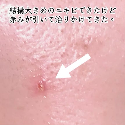 AZアゼライン酸15セラム/コスデバハ/美容液を使ったクチコミ(7枚目)