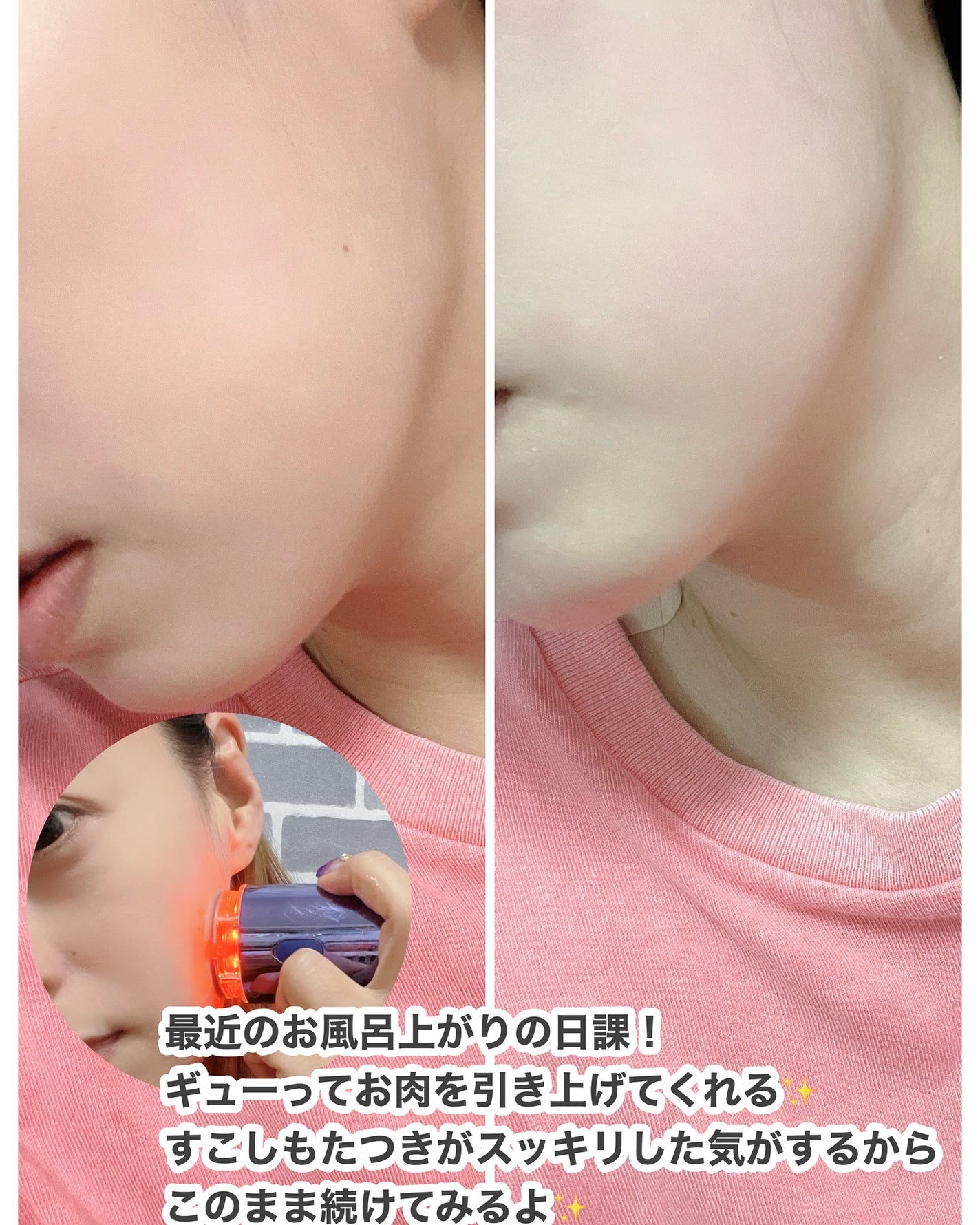 インモトックス小顔リフトアップペプチドショットクリーム&吸引ジェット/MEDITHERAPY/フェイスクリームを使ったクチコミ(5枚目)