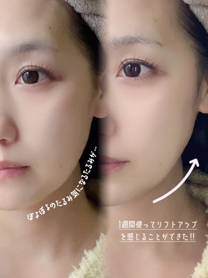 インモトックス小顔リフトアップペプチドショットクリーム&吸引ジェット/MEDITHERAPY/フェイスクリームを使ったクチコミ(4枚目)