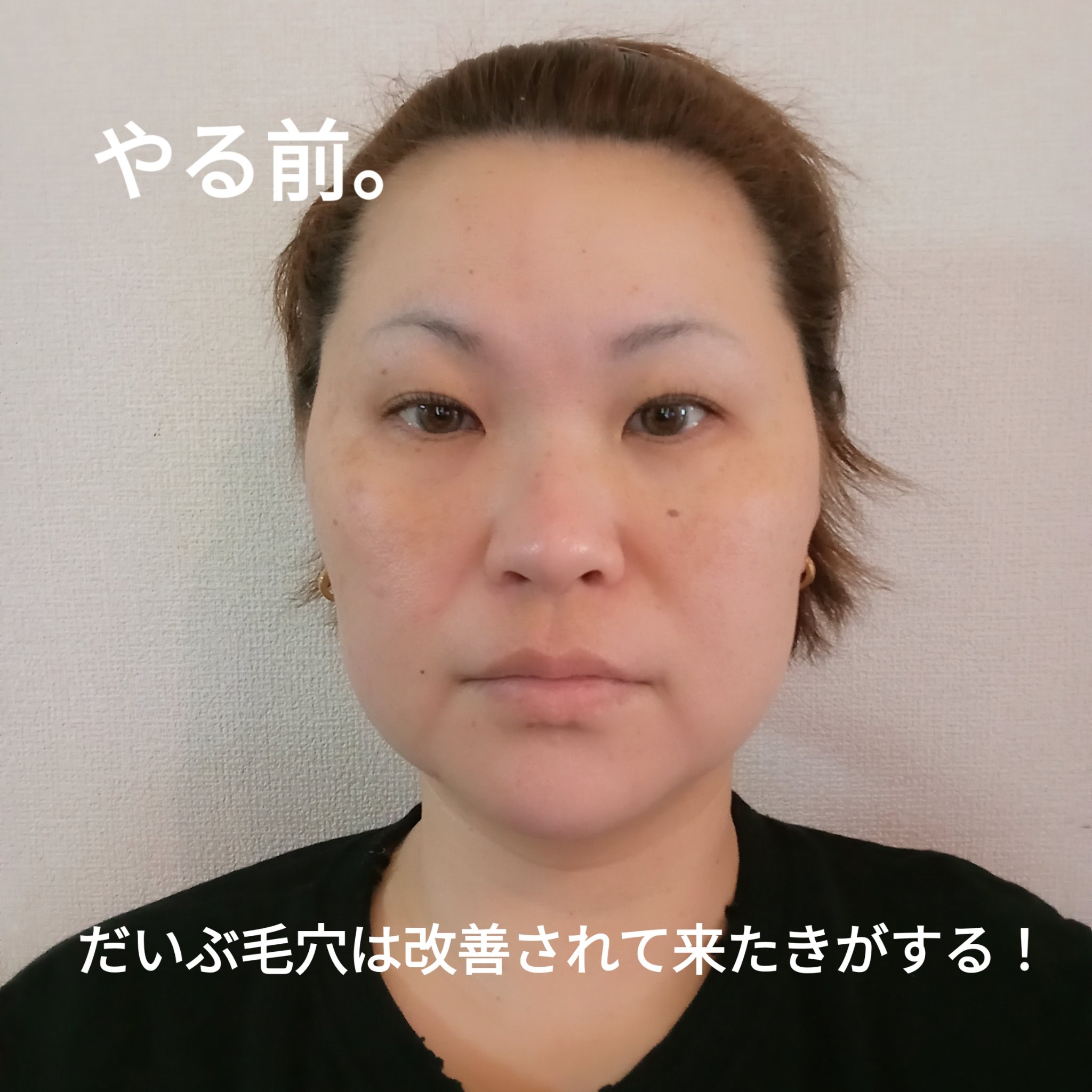 ダーマペン4/SBC/その他を使ったクチコミ（2枚目）