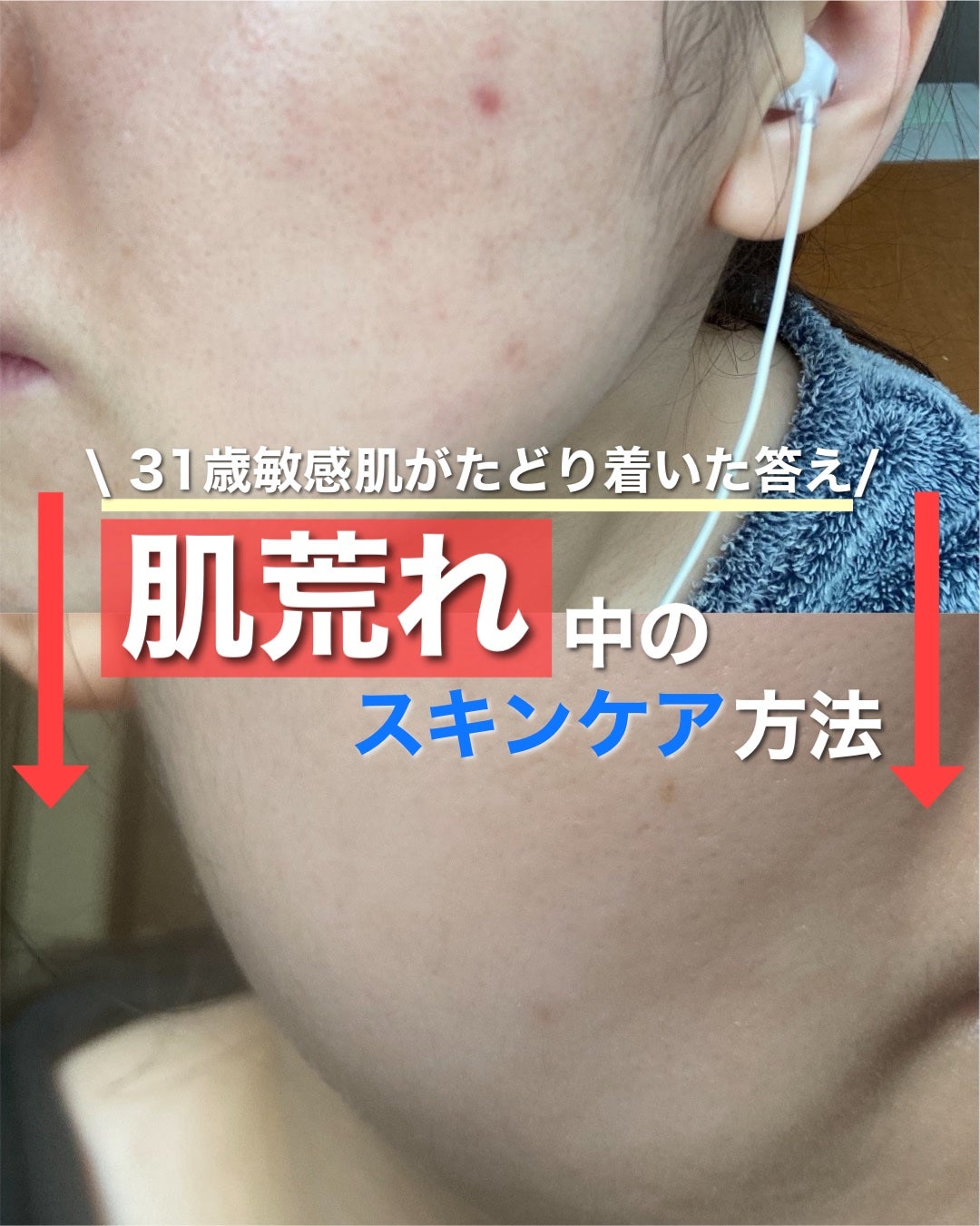 AD コントロール ローション/ACSEINE/化粧水を使ったクチコミ(1枚目)