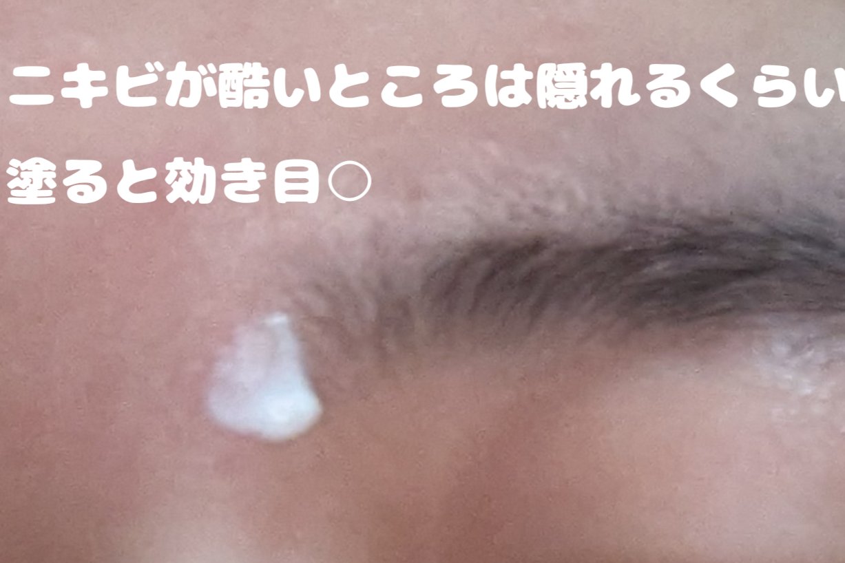 ペアアクネクリームW(医薬品)/ペア/その他を使ったクチコミ（2枚目）