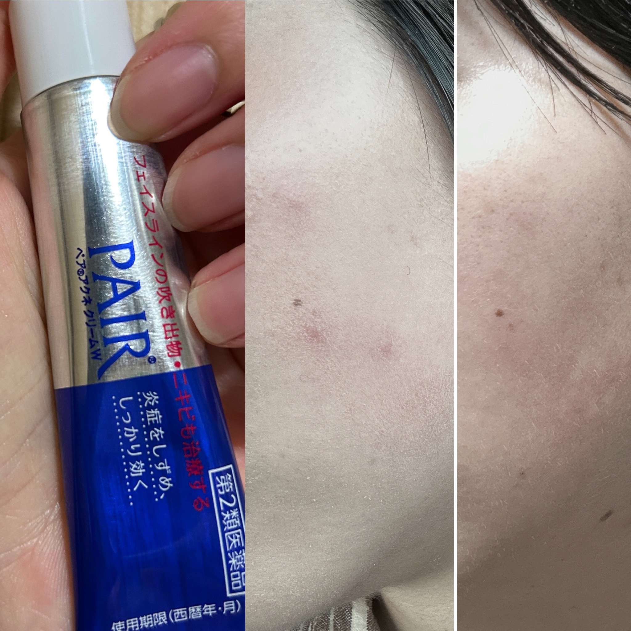 ペアアクネクリームW(医薬品)/ペア/その他を使ったクチコミ（1枚目）