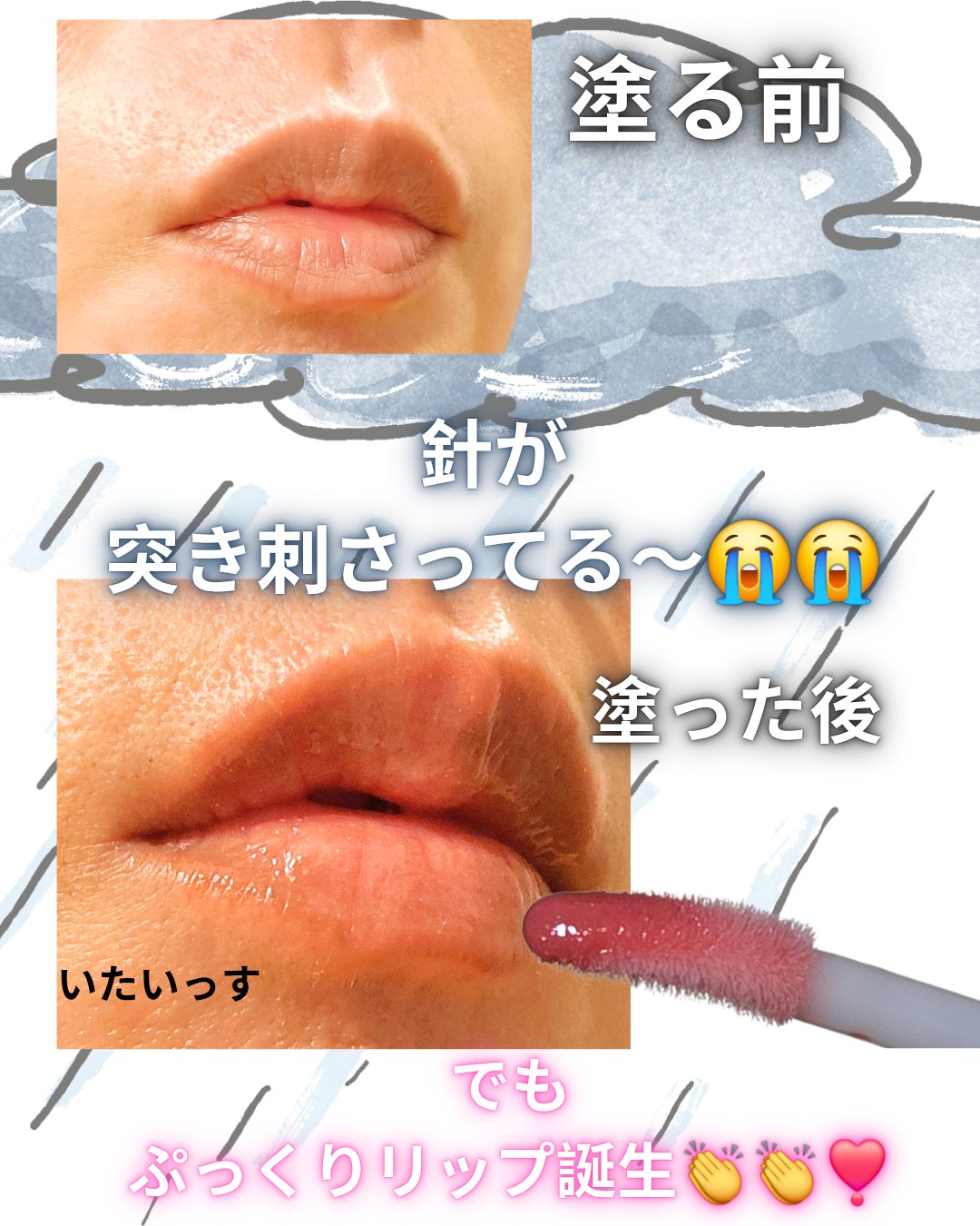 ニードルプランパー 電撃チェリー/Ui2./リッププランパーを使ったクチコミ（2枚目）