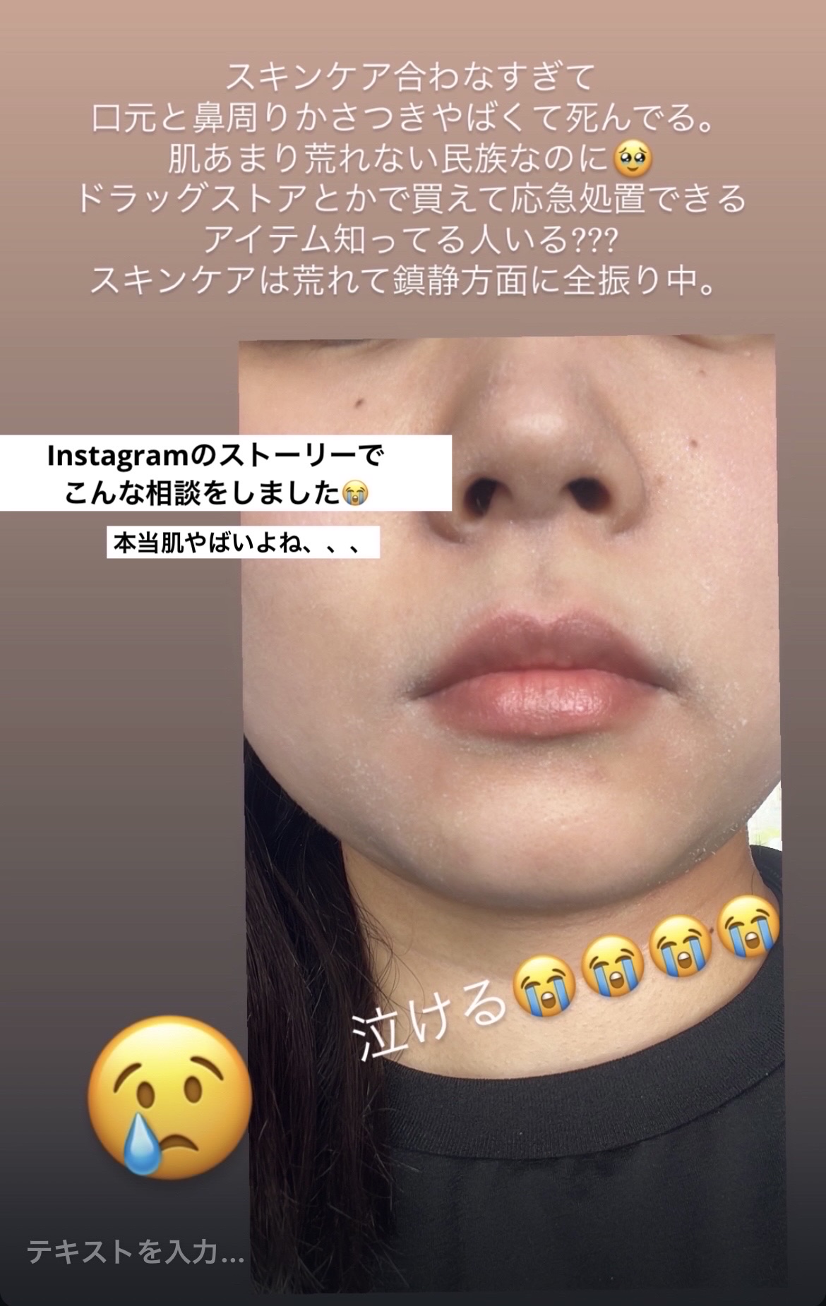 ペアアクネクリームW(医薬品)/ペア/その他を使ったクチコミ（2枚目）