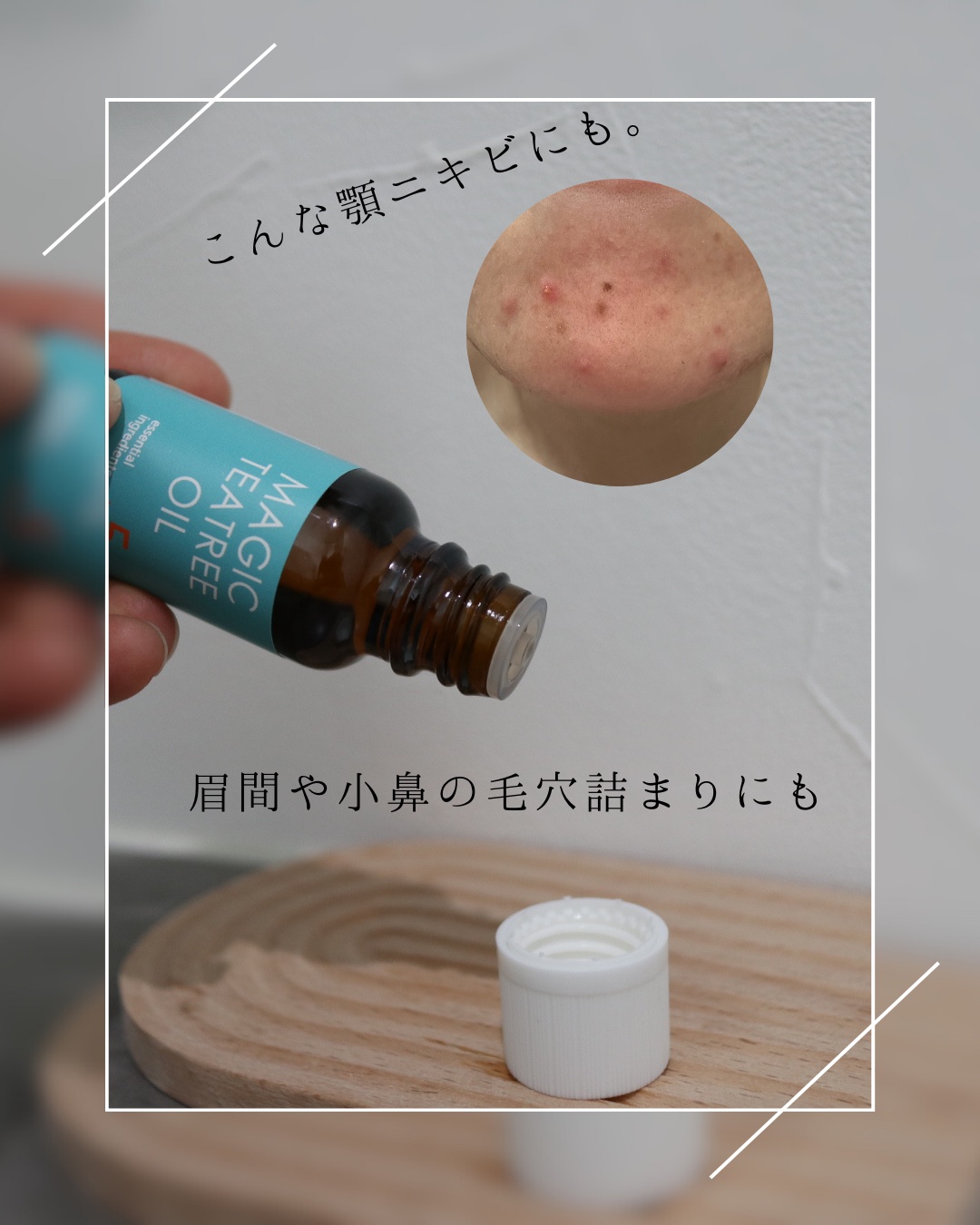 マジックティーツリーオイル/ブラン/フェイスオイルを使ったクチコミ（3枚目）