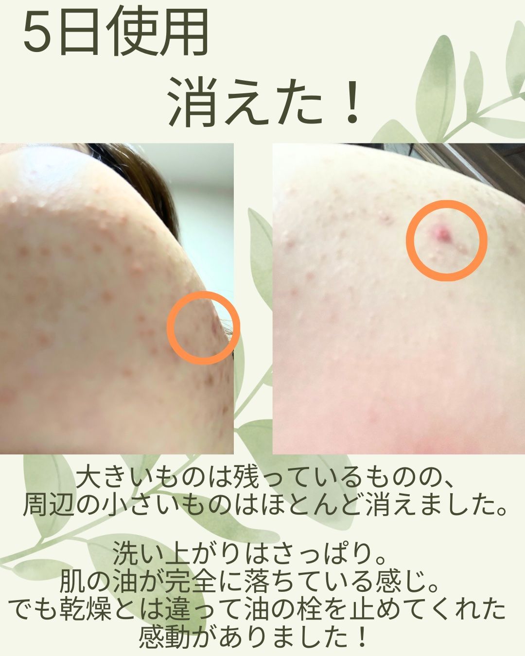 アクネケア 洗顔クリーム ＜医薬部外品＞/ファンケル/洗顔フォームを使ったクチコミ（2枚目）