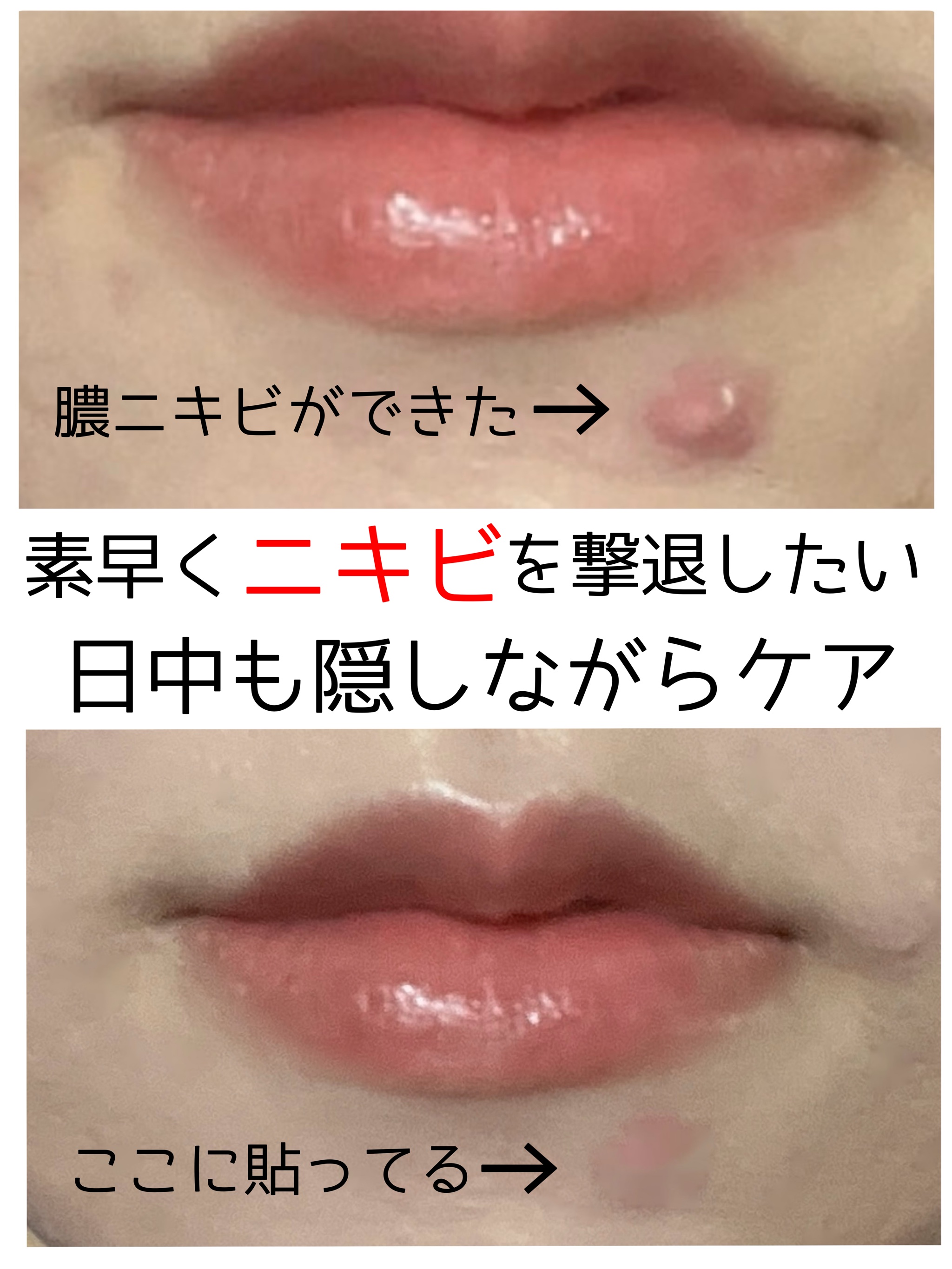 ビューティー スポットパッチ/イージーダムビューティー/にきびパッチを使ったクチコミ（1枚目）