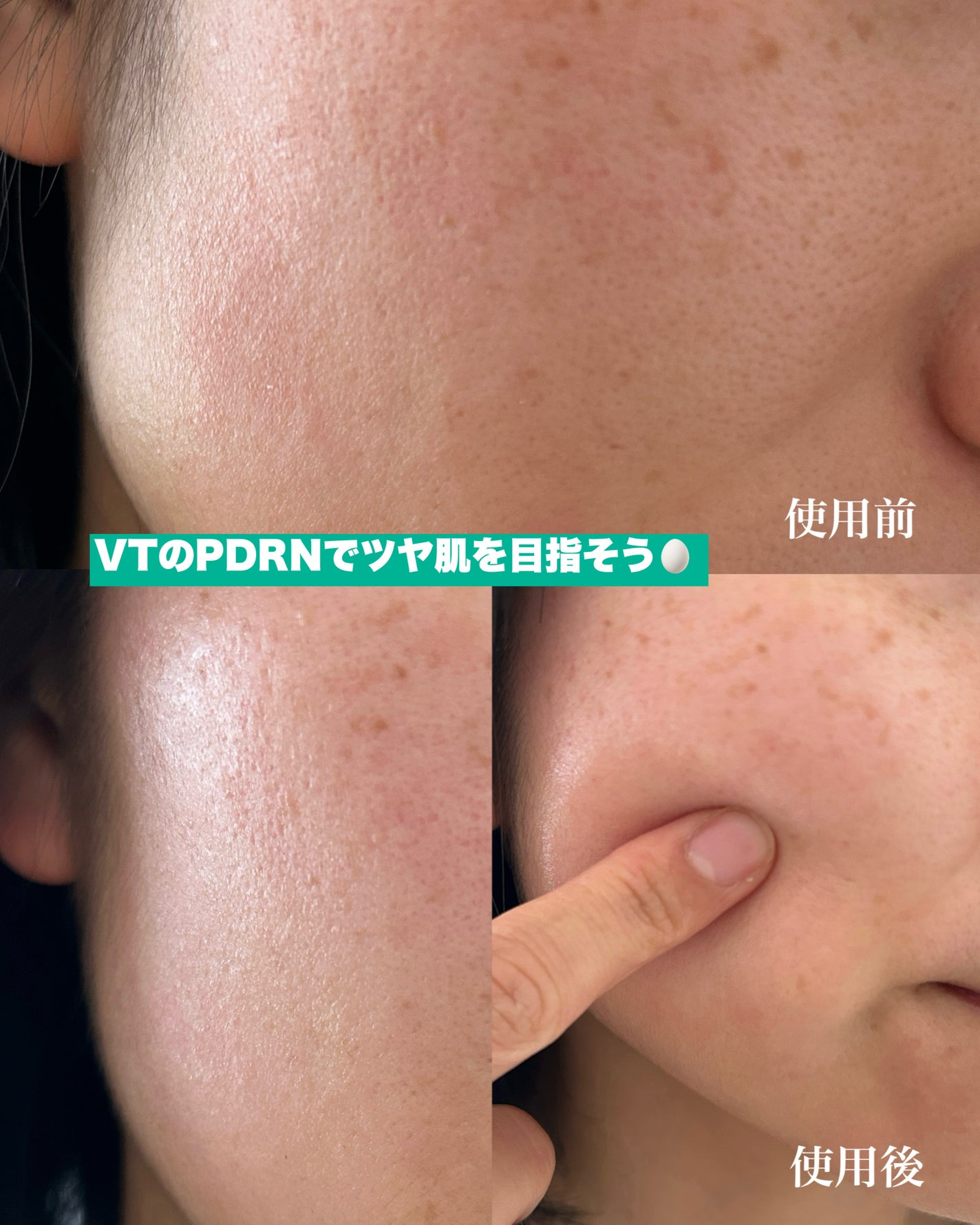 リードルS PDRN+ セラム/VT/美容液を使ったクチコミ(4枚目)