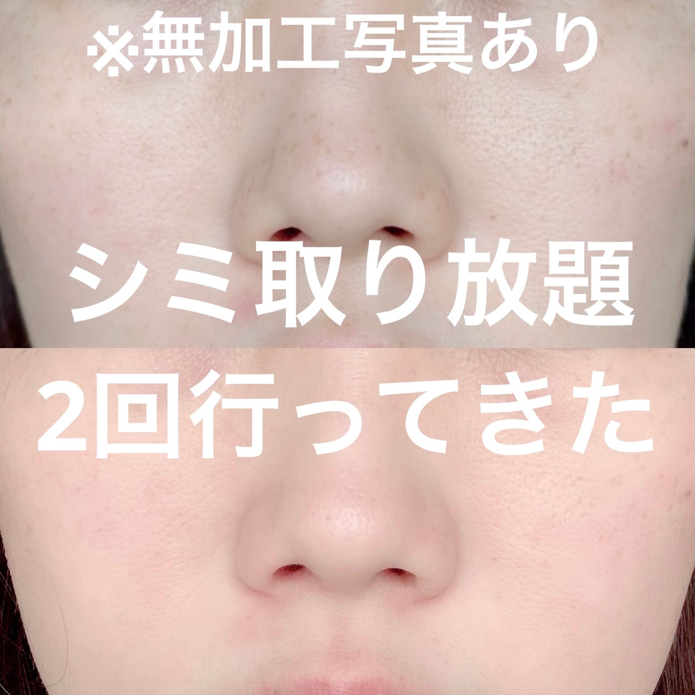 にゃみー★フォロバ投稿ある方 on LIPS 「シミ取り放題いってきた!ノマカメ無加工写真は2枚目!(鼻下だけ..」(1枚目)