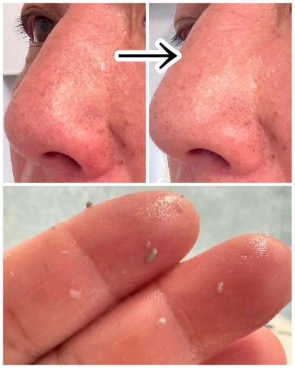 白米ピールショットゴマージュアンプル/Dr.Melaxin/美容液を使ったクチコミ(5枚目)