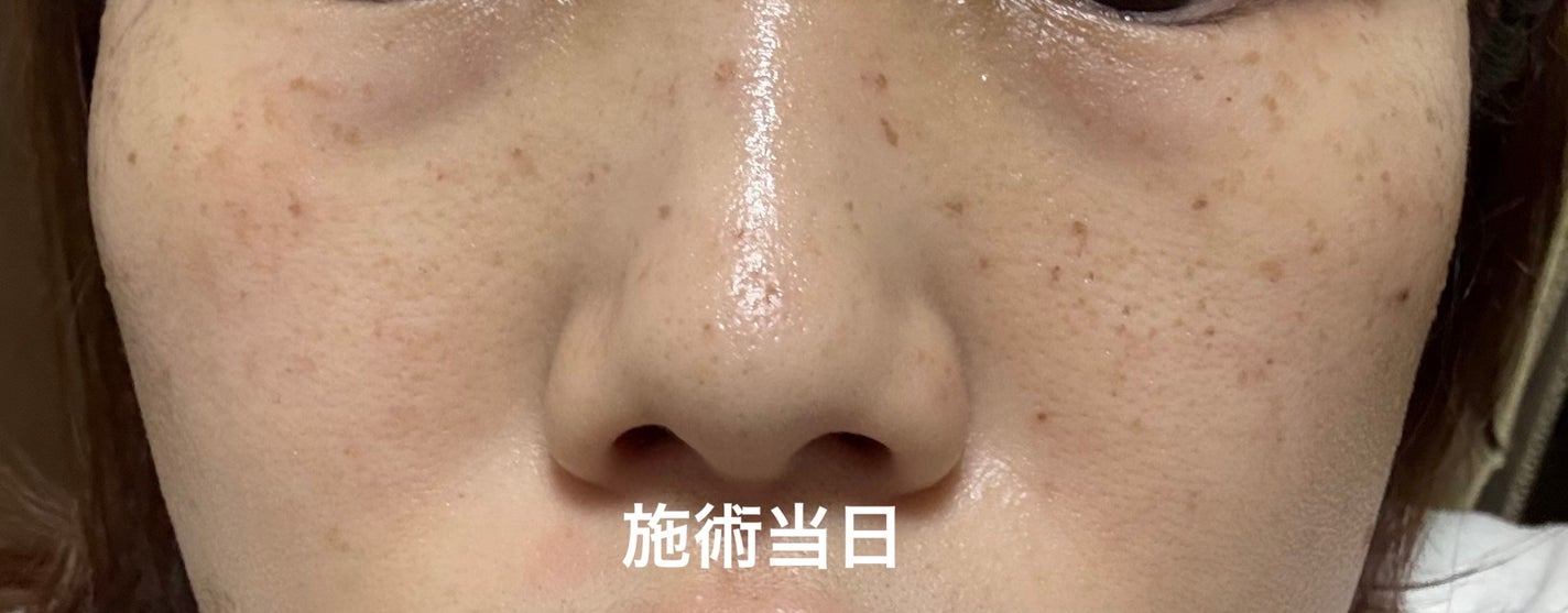 にゃみー★フォロバ投稿ある方 on LIPS 「シミ取り放題いってきた!ノマカメ無加工写真は2枚目!(鼻下だけ..」(3枚目)