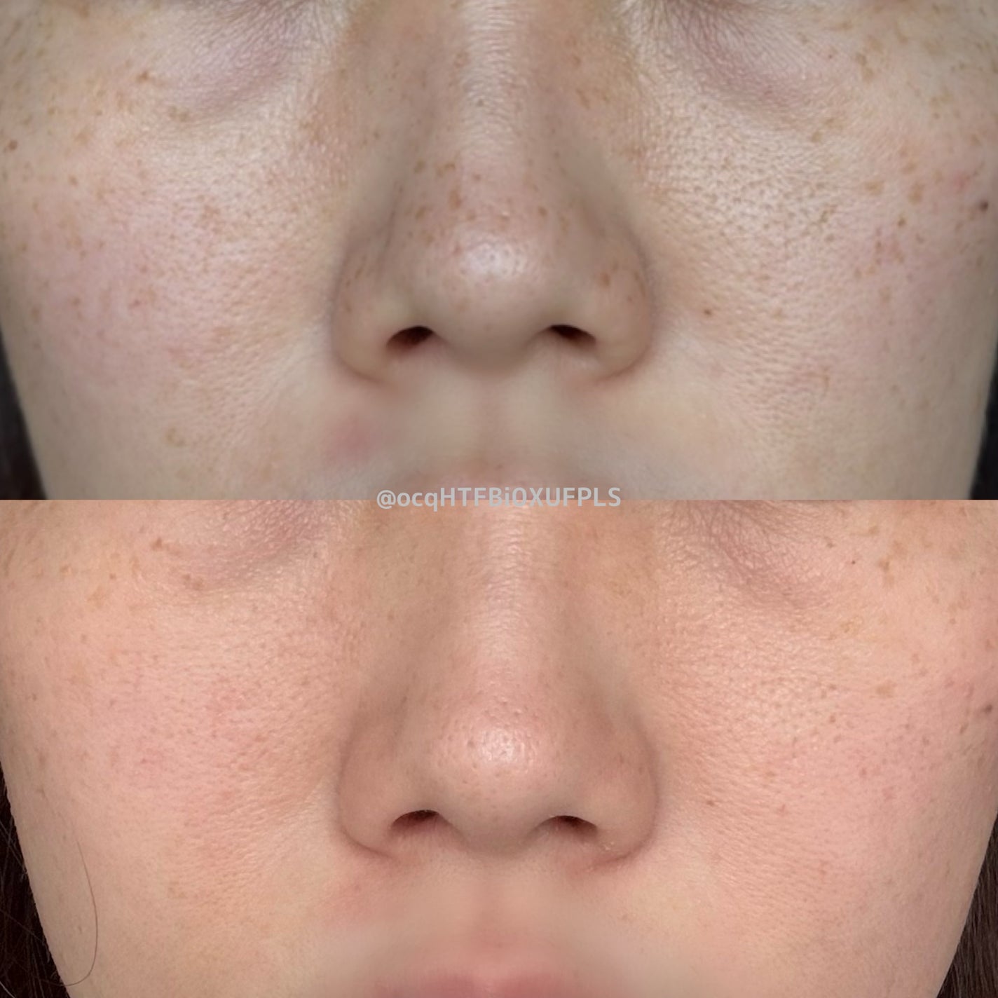 にゃみー★フォロバ投稿ある方 on LIPS 「シミ取り放題いってきた!ノマカメ無加工写真は2枚目!(鼻下だけ..」(2枚目)