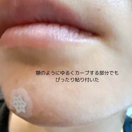 ACマグネシウムパッチ/スノーツープラス/シートマスク・パックを使ったクチコミ(6枚目)