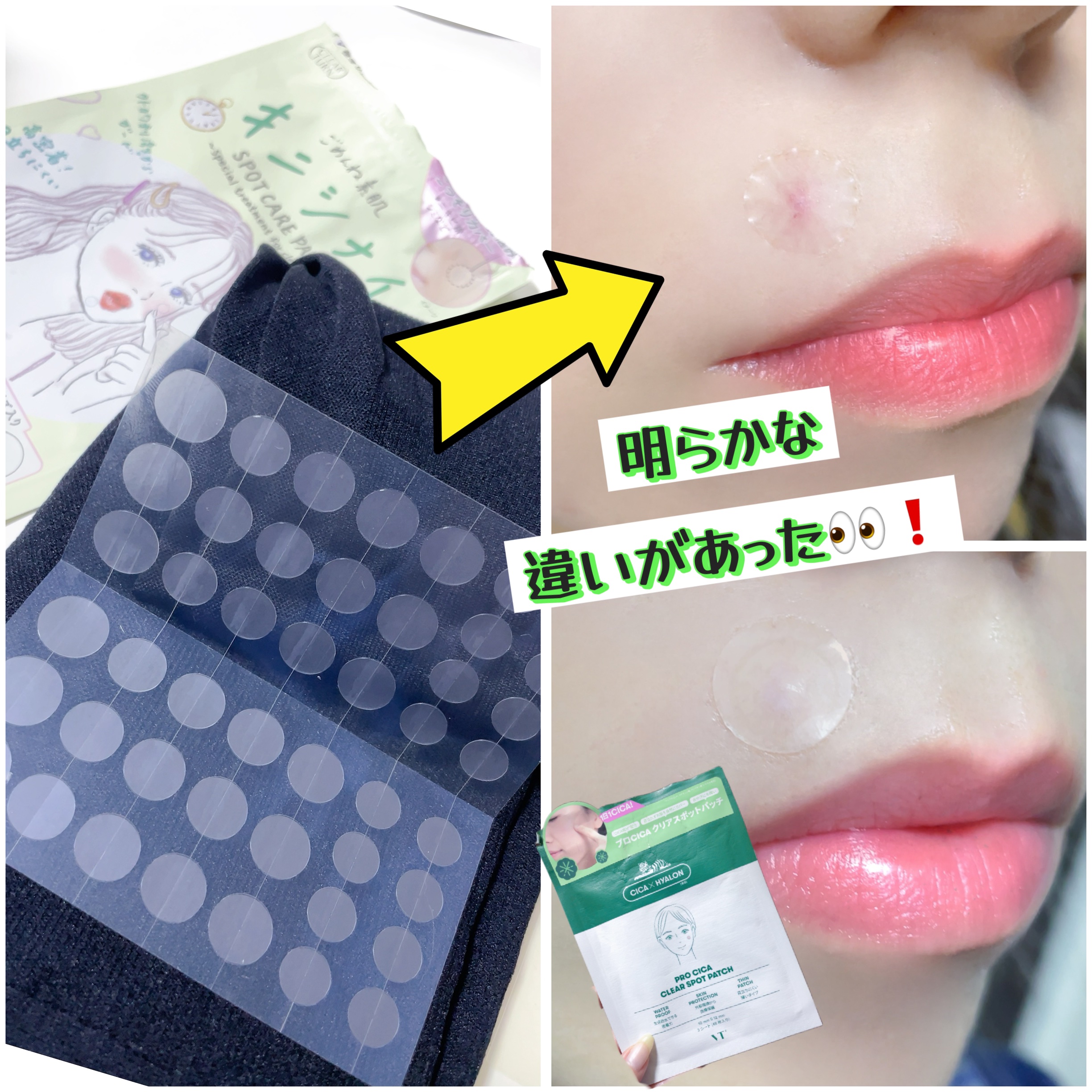 プロCICA クリアスポットパッチ/VT/その他スキンケアを使ったクチコミ（2枚目）