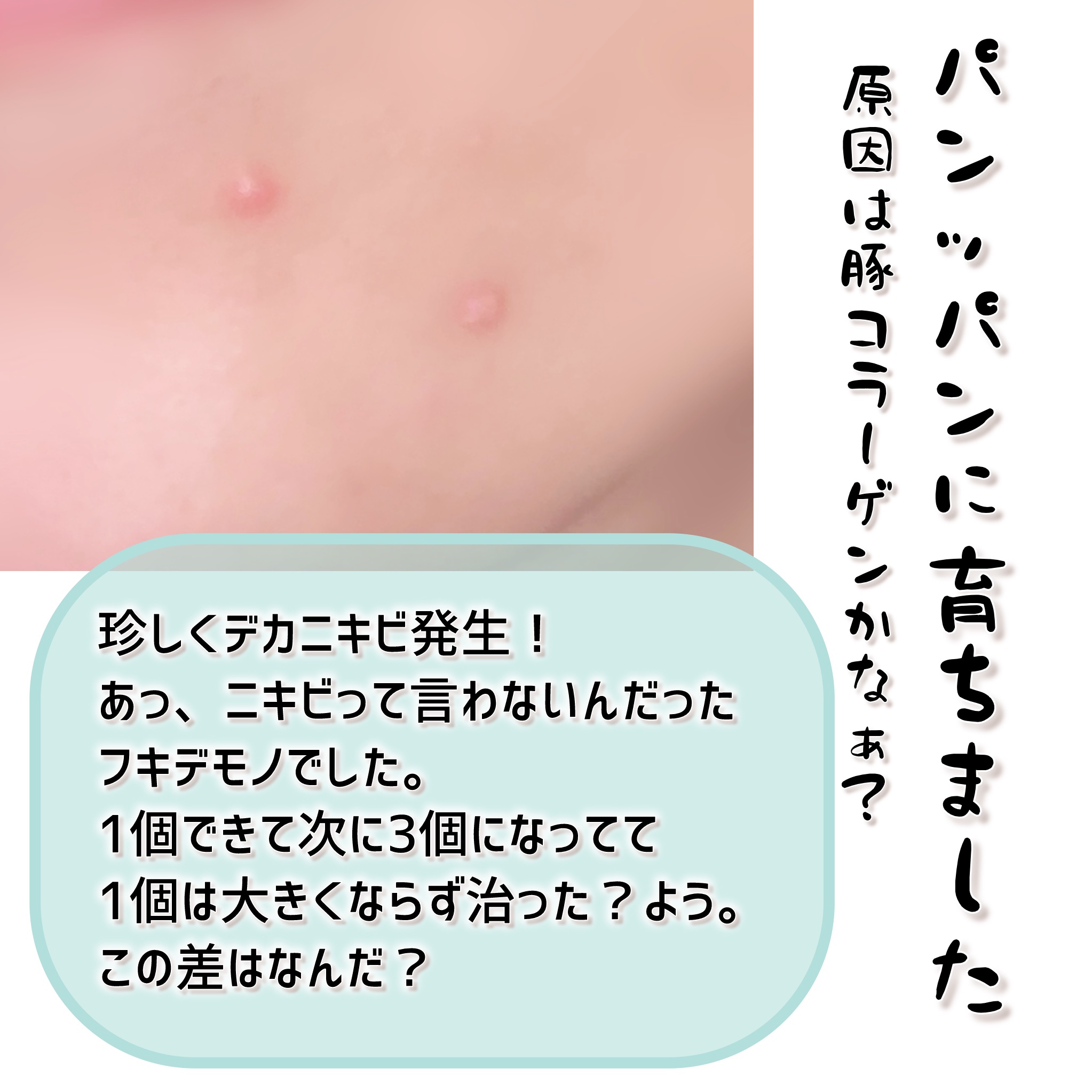 ALLDAY CLEAR PATCH/P.CALM/にきびパッチを使ったクチコミ（2枚目）