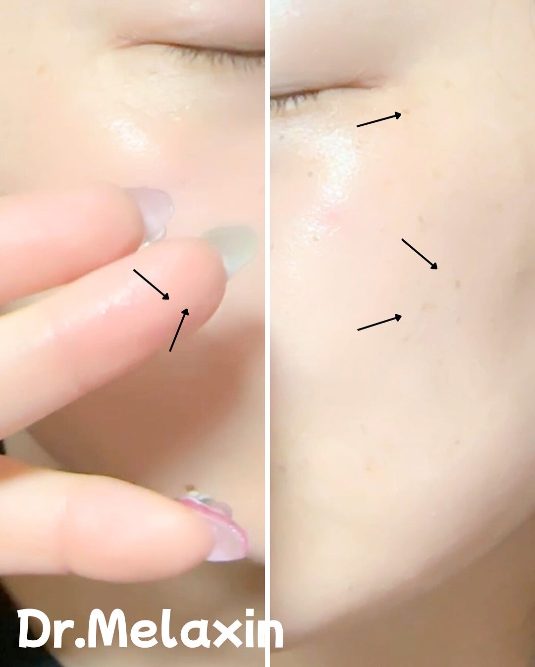 白米ピールショットゴマージュアンプル/Dr.Melaxin/美容液を使ったクチコミ(4枚目)