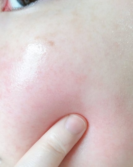 ベターツリカン肌荒れ美容液/Mildlab/美容液を使ったクチコミ(5枚目)