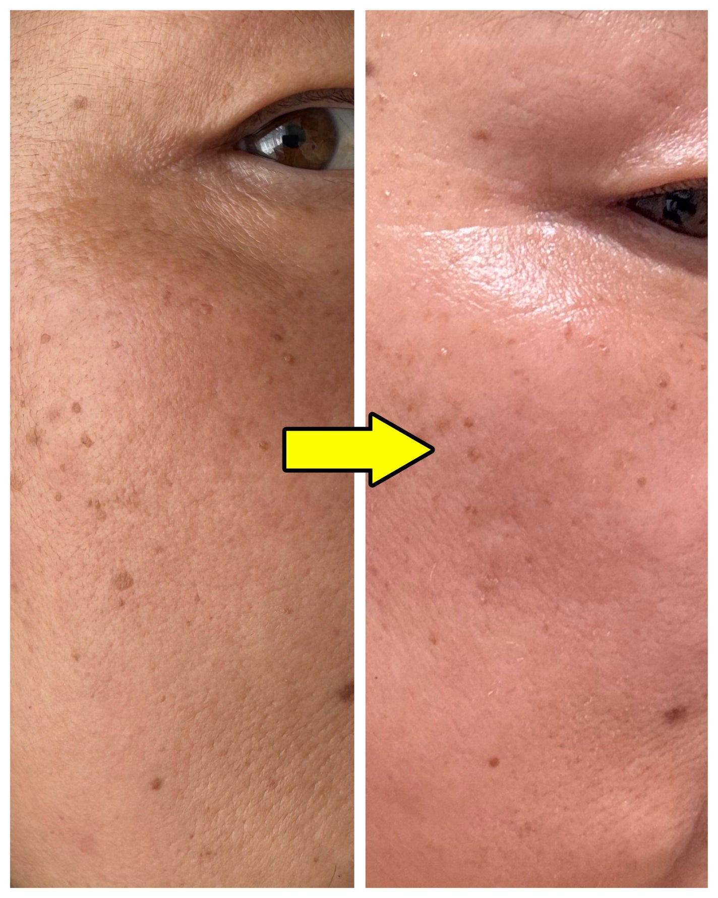 pikopiko on LIPS 「最近SNSでも話題の【レチナールクリーム】ついに使ってみたよ〜..」(5枚目)