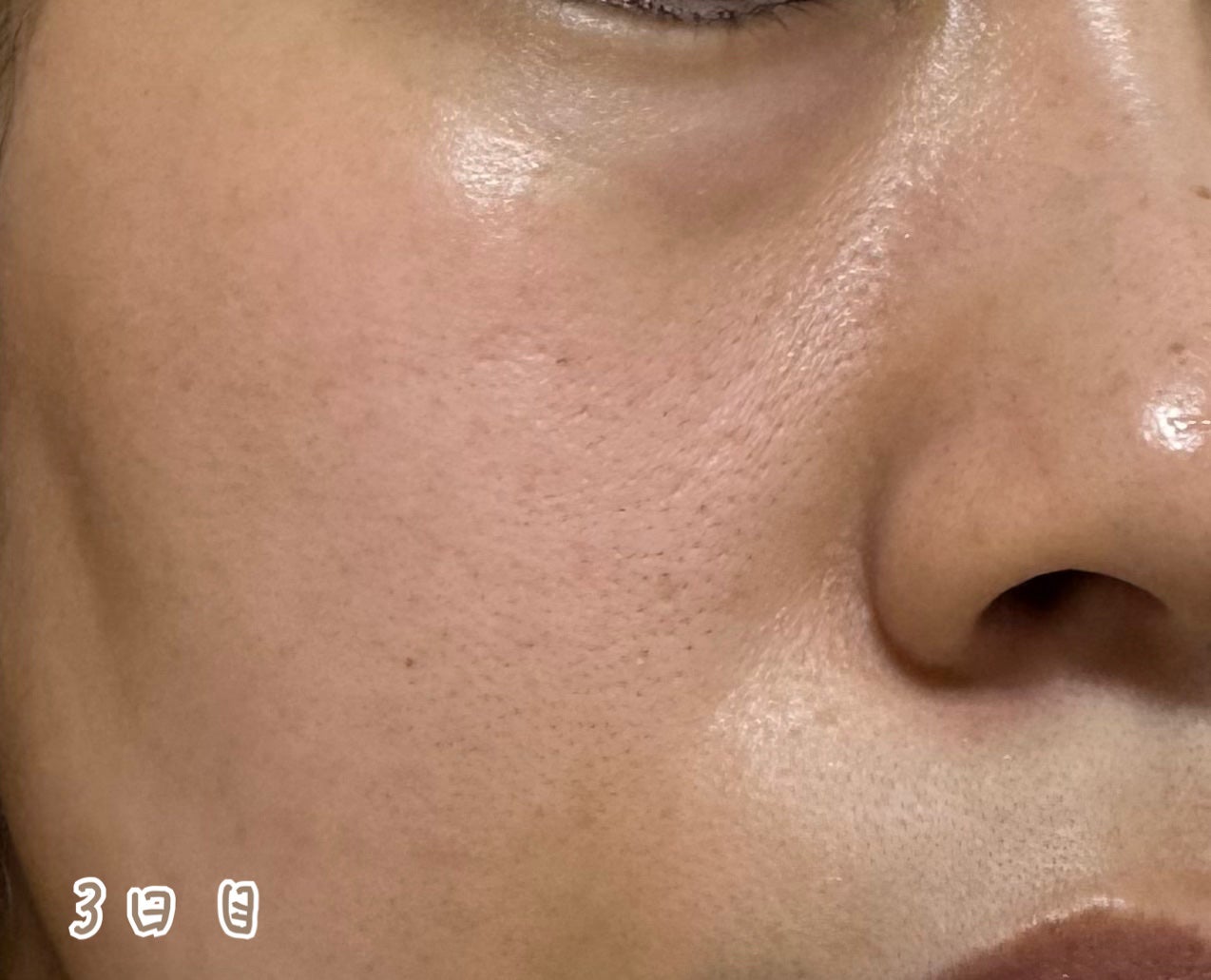 リードルS PDRN+ セラム/VT/美容液を使ったクチコミ(5枚目)