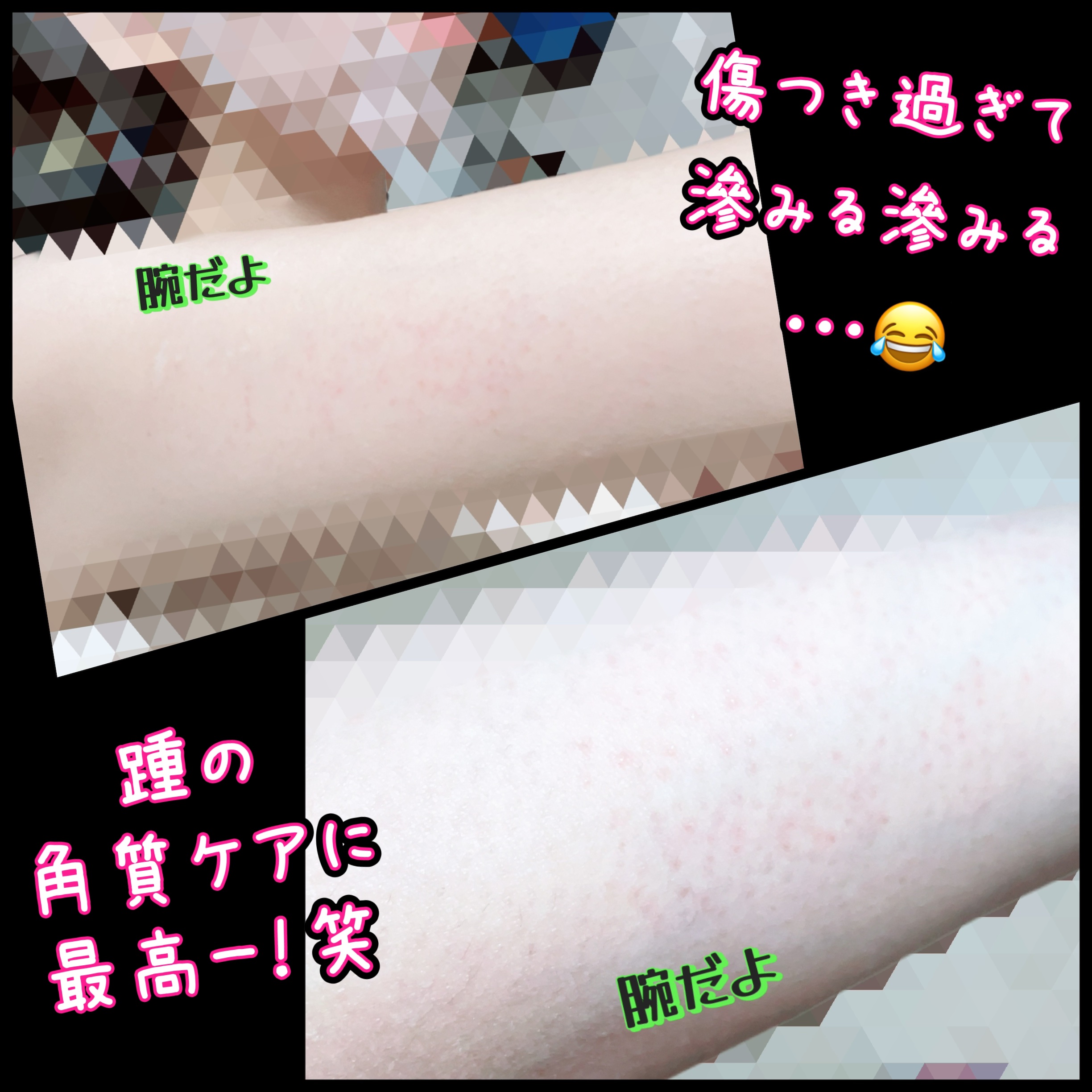 ガラスリムーバー/株式会社イーストメディカル/ムダ毛ケアを使ったクチコミ（2枚目）