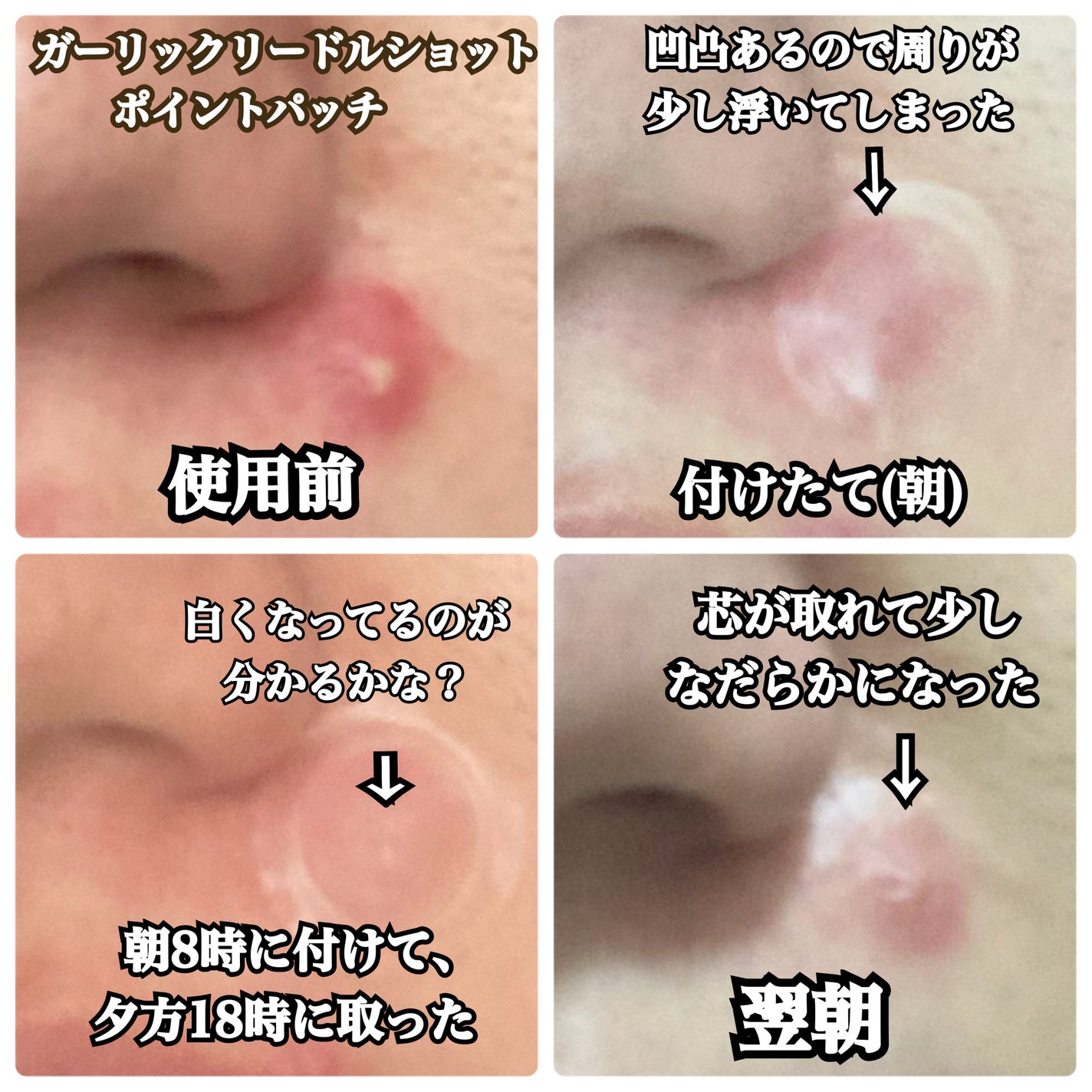 ガーリック リードルショット ポイントパッチ/VT/その他スキンケアを使ったクチコミ(4枚目)