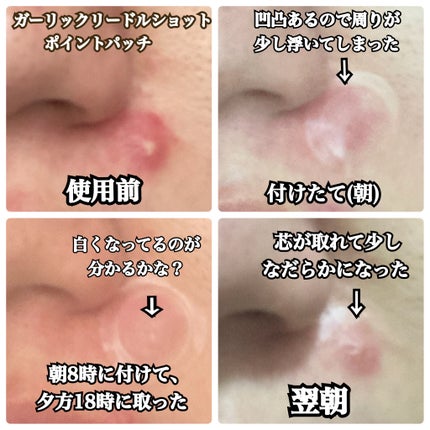 ガーリック リードルショット ポイントパッチ/VT/その他スキンケアを使ったクチコミ(4枚目)
