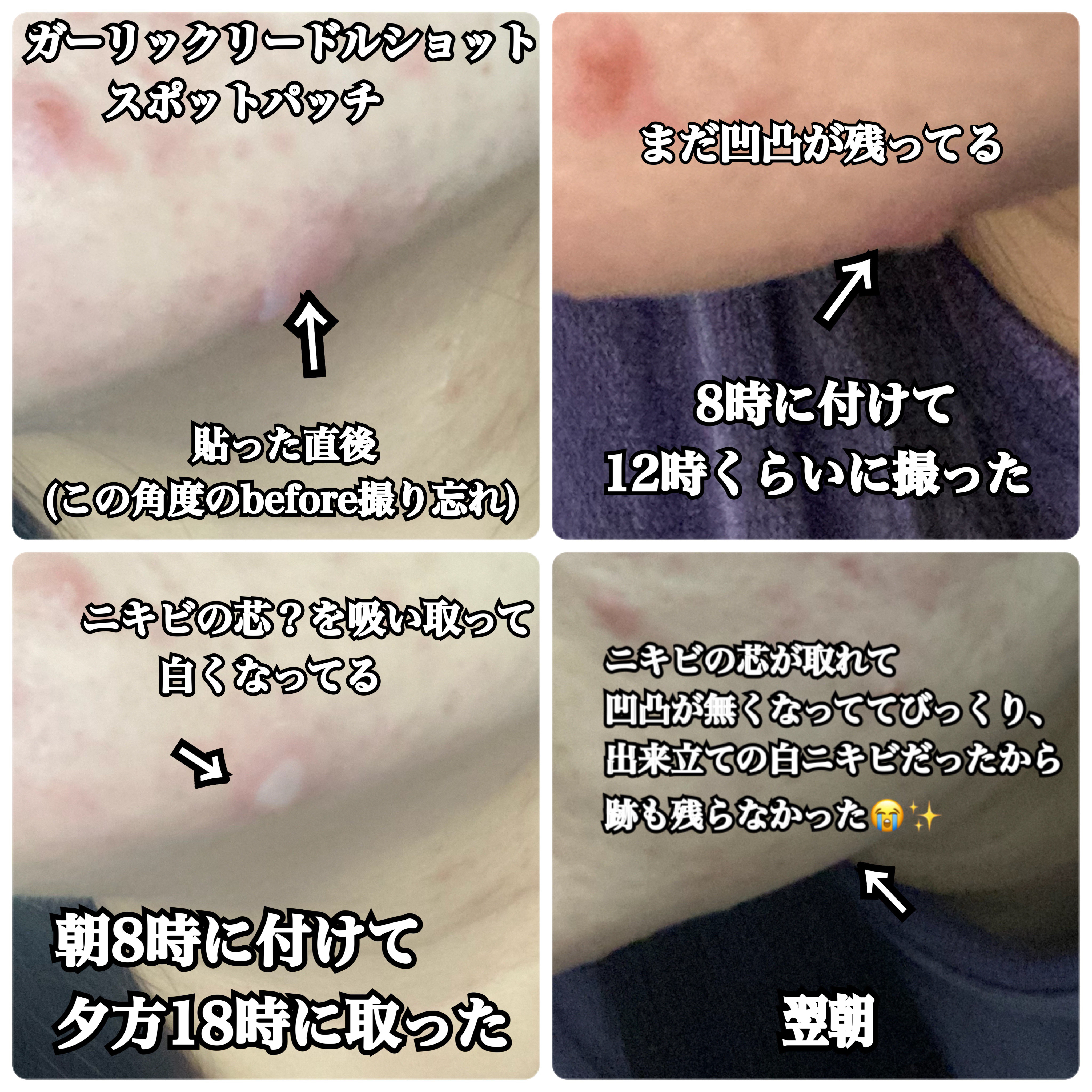 ガーリック リードルショット ポイントパッチ/VT/その他スキンケアを使ったクチコミ（3枚目）