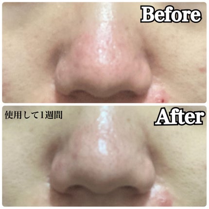 3番 ブルーバイオレチノール3D毛穴アンプル/numbuzin/美容液を使ったクチコミ(6枚目)