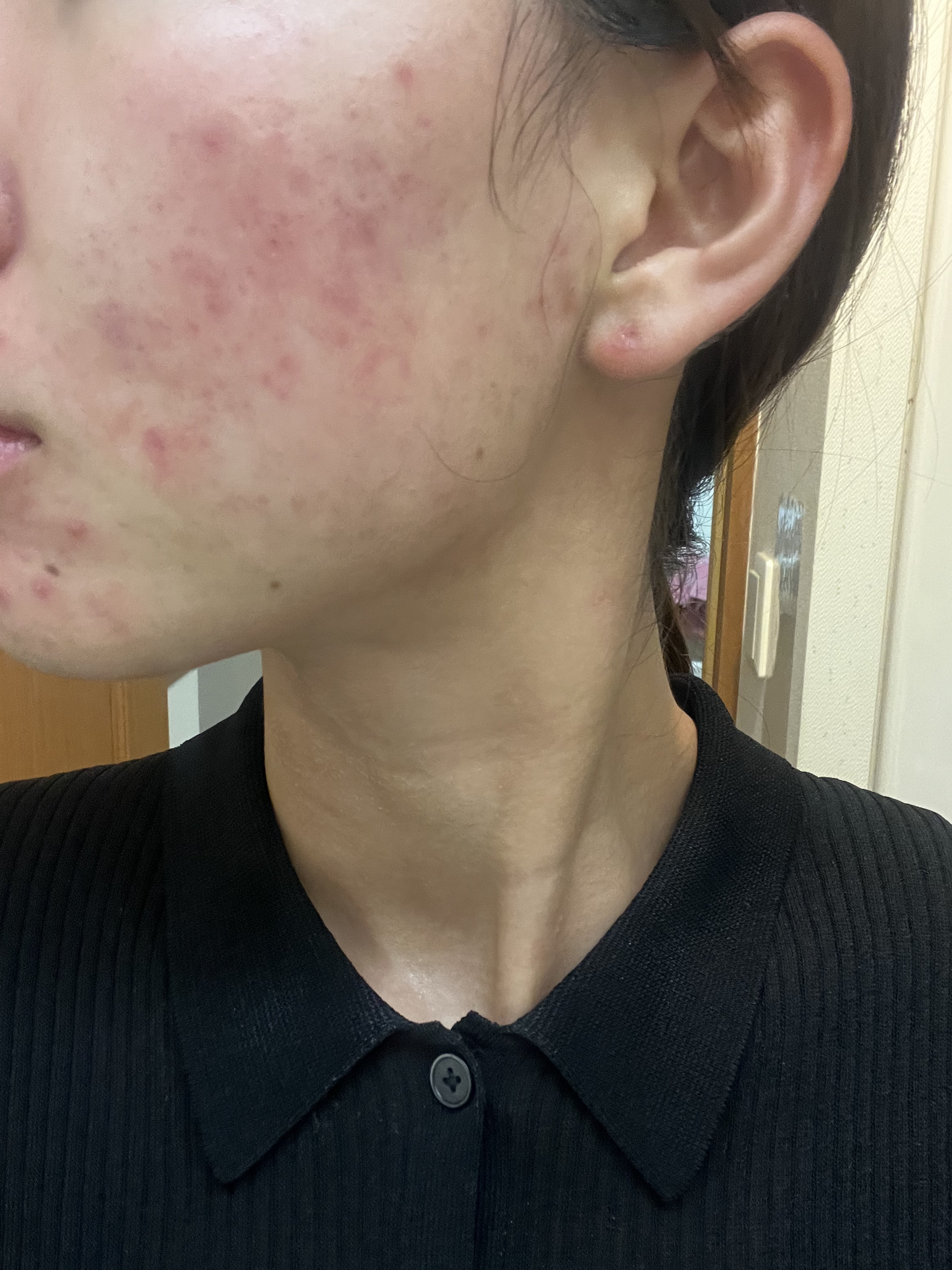 白潤プレミアム 薬用浸透美白乳液/肌ラボ/乳液を使ったクチコミ（3枚目）