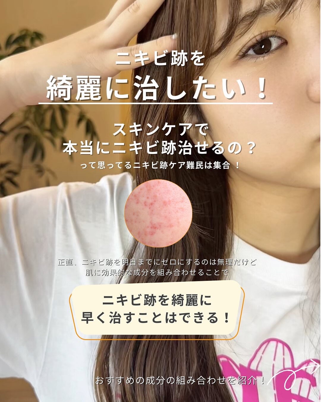白湯(サユ) | ニキビと戦うOL🤍 on LIPS 「・白湯です!ニキビ跡がなかなか綺麗に治らなくてコンシーラーを手..」(2枚目)