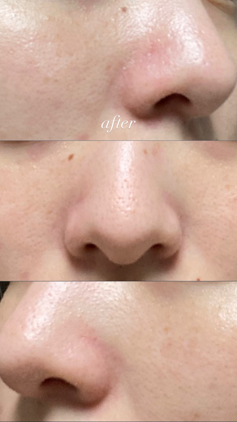 AZケア クレンジングオイル/VT/オイルクレンジングを使ったクチコミ（3枚目）