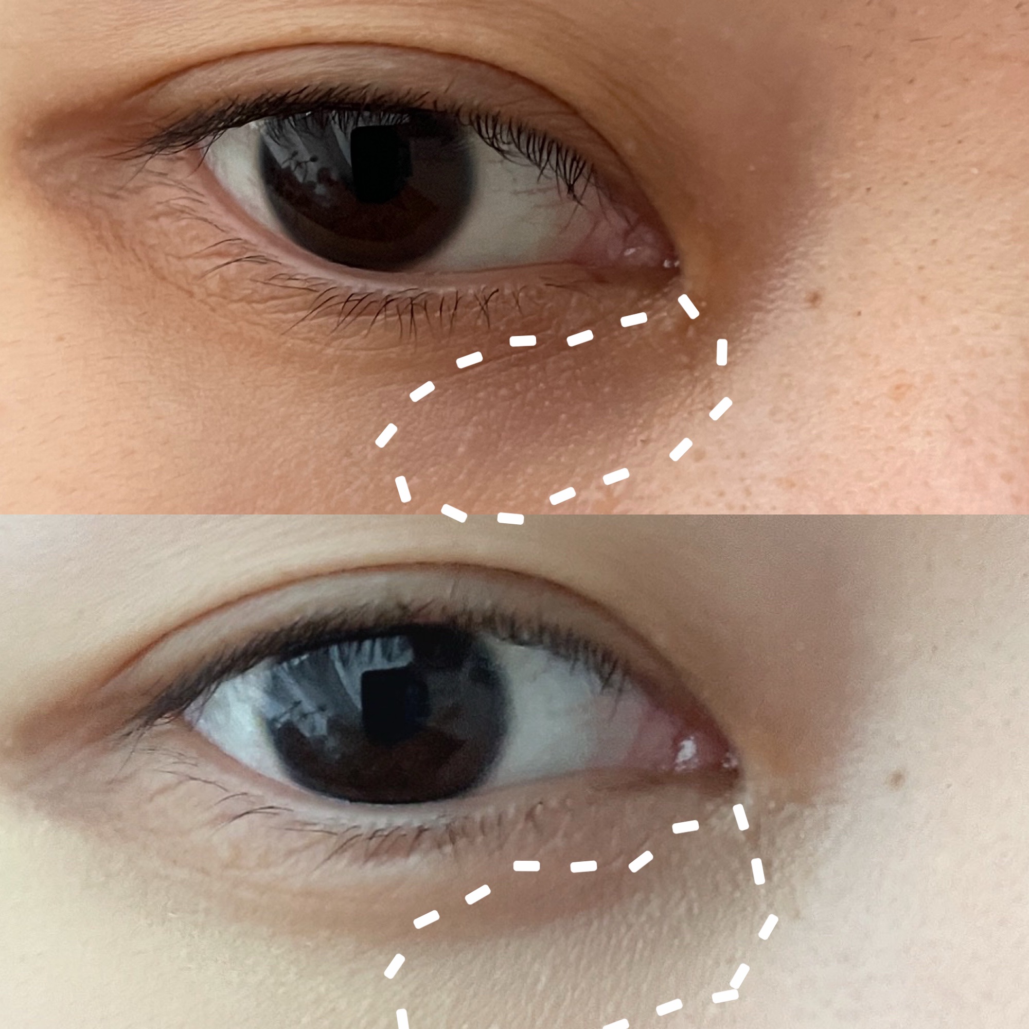 ダイヤモンドティップス コンシーラー＜カバータイプ＞/JILL STUART/リキッドコンシーラーを使ったクチコミ（3枚目）