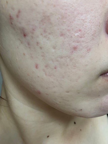 潤浸保湿 化粧水 III とてもしっとり/キュレル/化粧水を使ったクチコミ(5枚目)