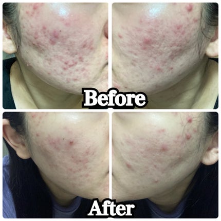 ガーリック リードルショット スポットクリーム/VT/フェイスクリームを使ったクチコミ(5枚目)