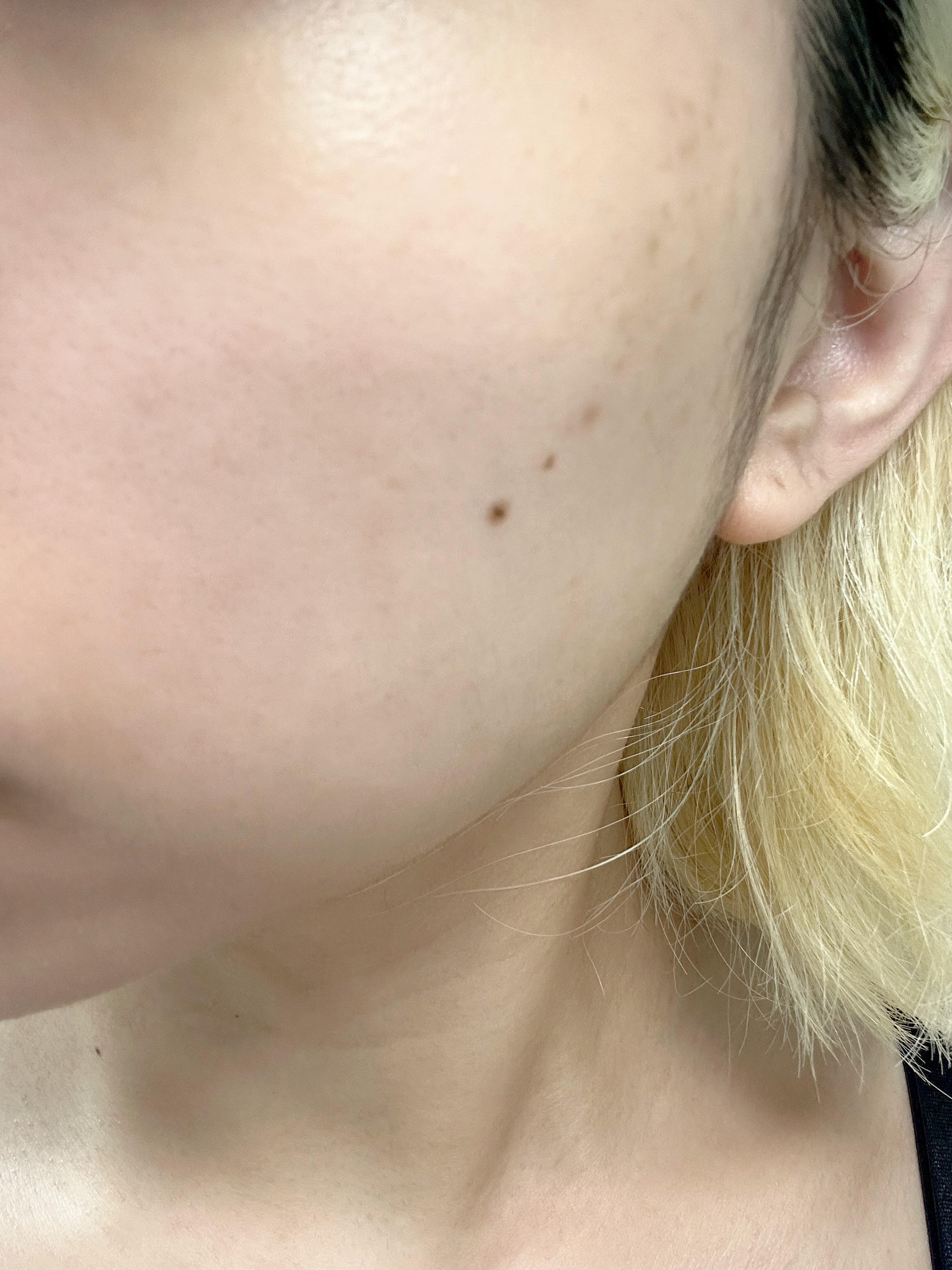 RXザ・アルファアルブチン2 ニキビ跡ケアセラム/COSRX/美容液を使ったクチコミ（3枚目）