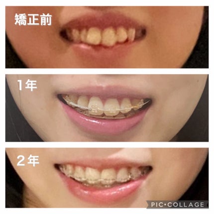 りん☁️ on LIPS 「【矯正前に必ず読んで!】インビザラインとワイヤー矯正の違い&病..」(5枚目)