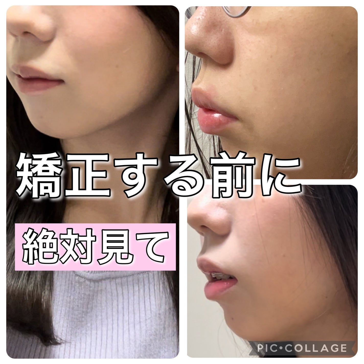 りん☁️ on LIPS 「【矯正前に必ず読んで!】インビザラインとワイヤー矯正の違い&病..」(1枚目)