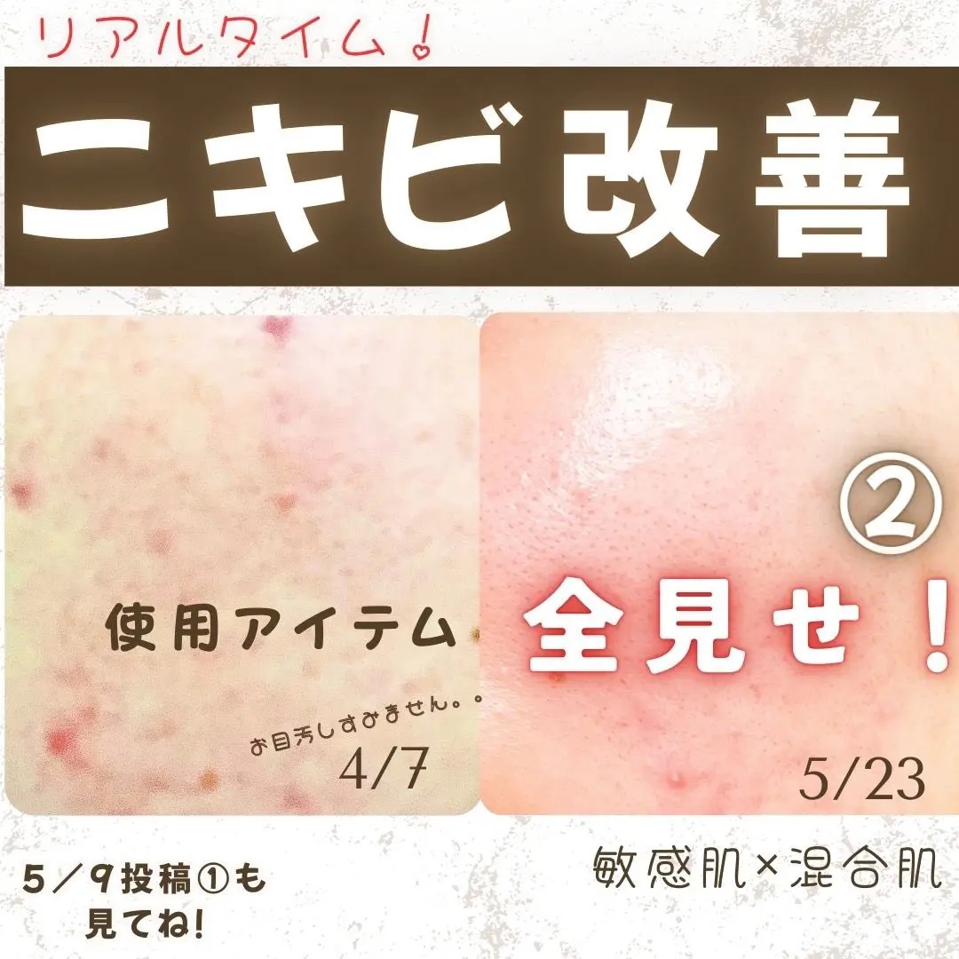 オードムーゲ 薬用ローション（ふきとり化粧水）/オードムーゲ/拭き取り化粧水を使ったクチコミ（1枚目）