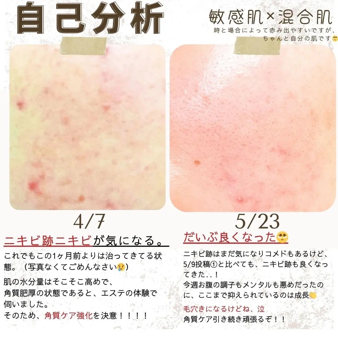 オードムーゲ 薬用ローション（ふきとり化粧水）/オードムーゲ/拭き取り化粧水を使ったクチコミ（2枚目）