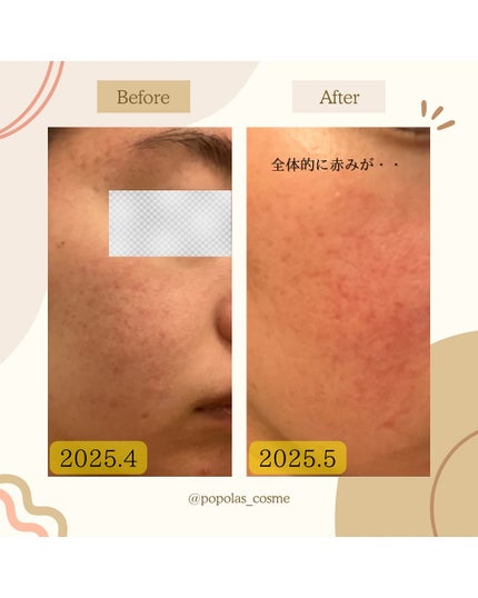 アミノ酸あわ洗顔料/Mマークシリーズ/泡洗顔を使ったクチコミ(5枚目)