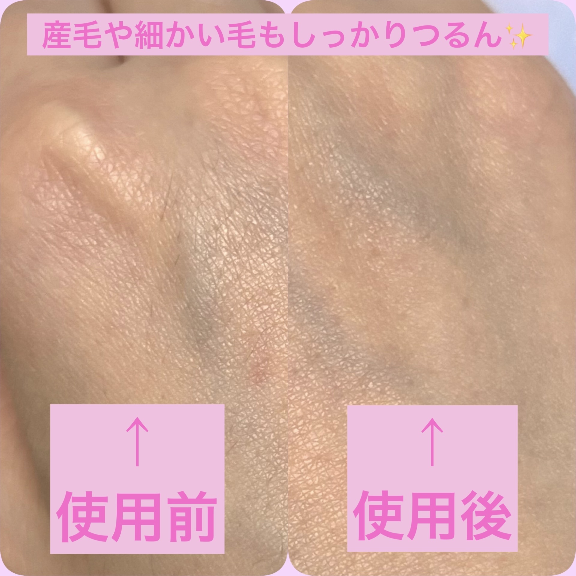 miness bi-hada ompa L/貝印/シェーバーを使ったクチコミ（3枚目）