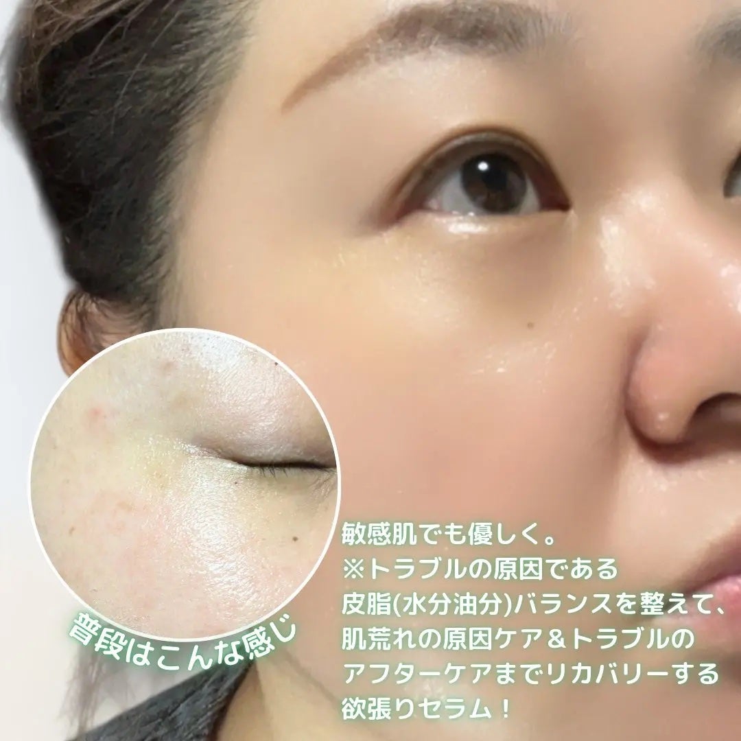 青麦ジンクセラム/Veganifect/美容液を使ったクチコミ(4枚目)