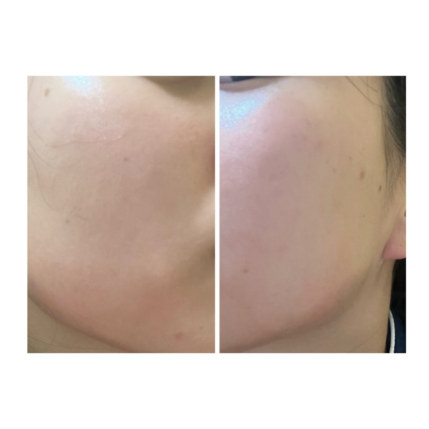 ぽむ on LIPS 「2023.9.13皮膚科に受診 エピデュオとヘパリン処方1枚目..」(2枚目)