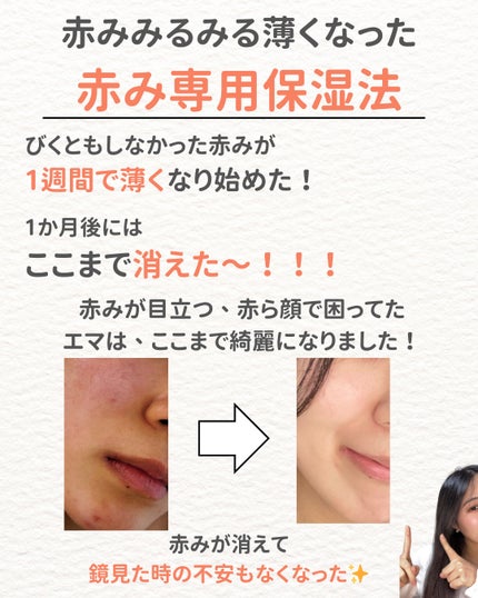 ニキビを諦めかけた人の味方|エマ🫧 on LIPS 「赤み消し飛んだ!!ほんとに正しい保湿法✨赤みに効くって噂のシカ..」(6枚目)