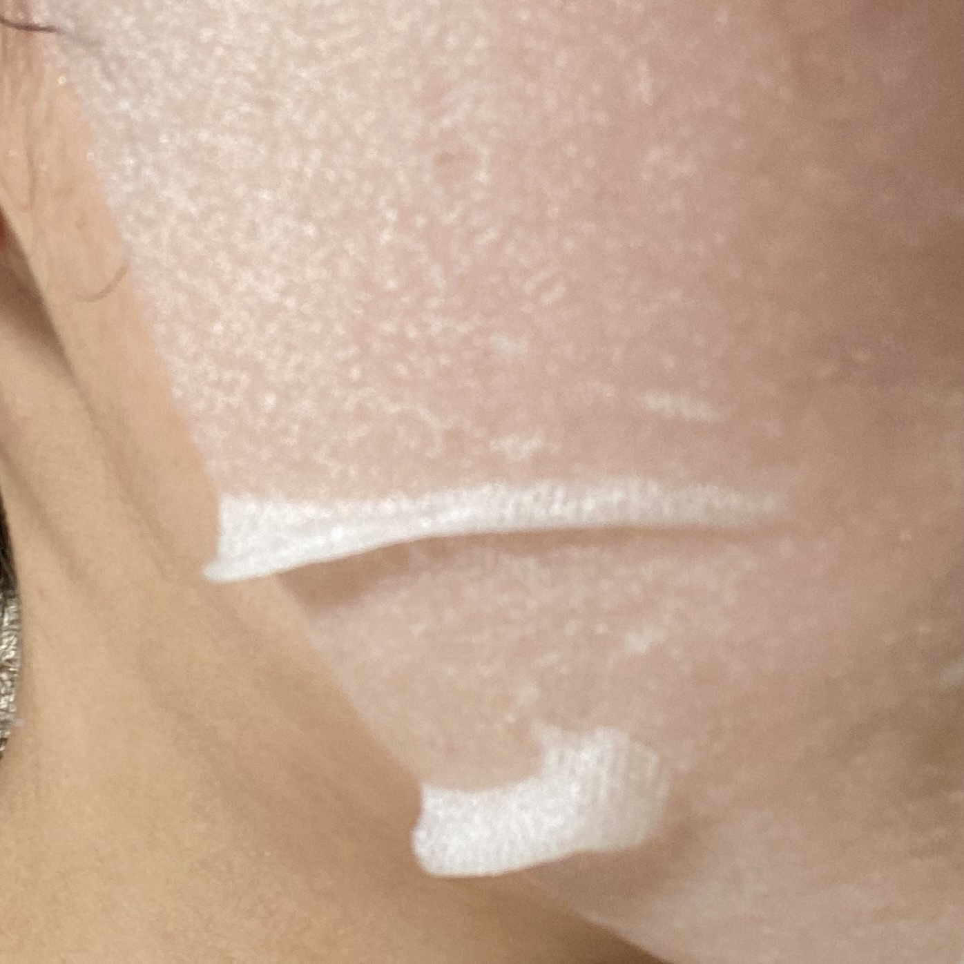 ダーマレーザー スーパーTEATREE100マスク/クオリティファースト/シートマスク・パックを使ったクチコミ（2枚目）