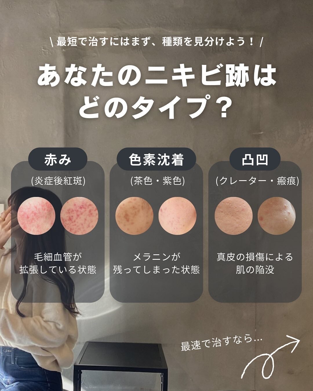 白湯(サユ) | ニキビと戦うOL🤍 on LIPS 「・白湯です🫶🏻今回はよく質問をいただくニキビ跡について!ニキビ..」(2枚目)