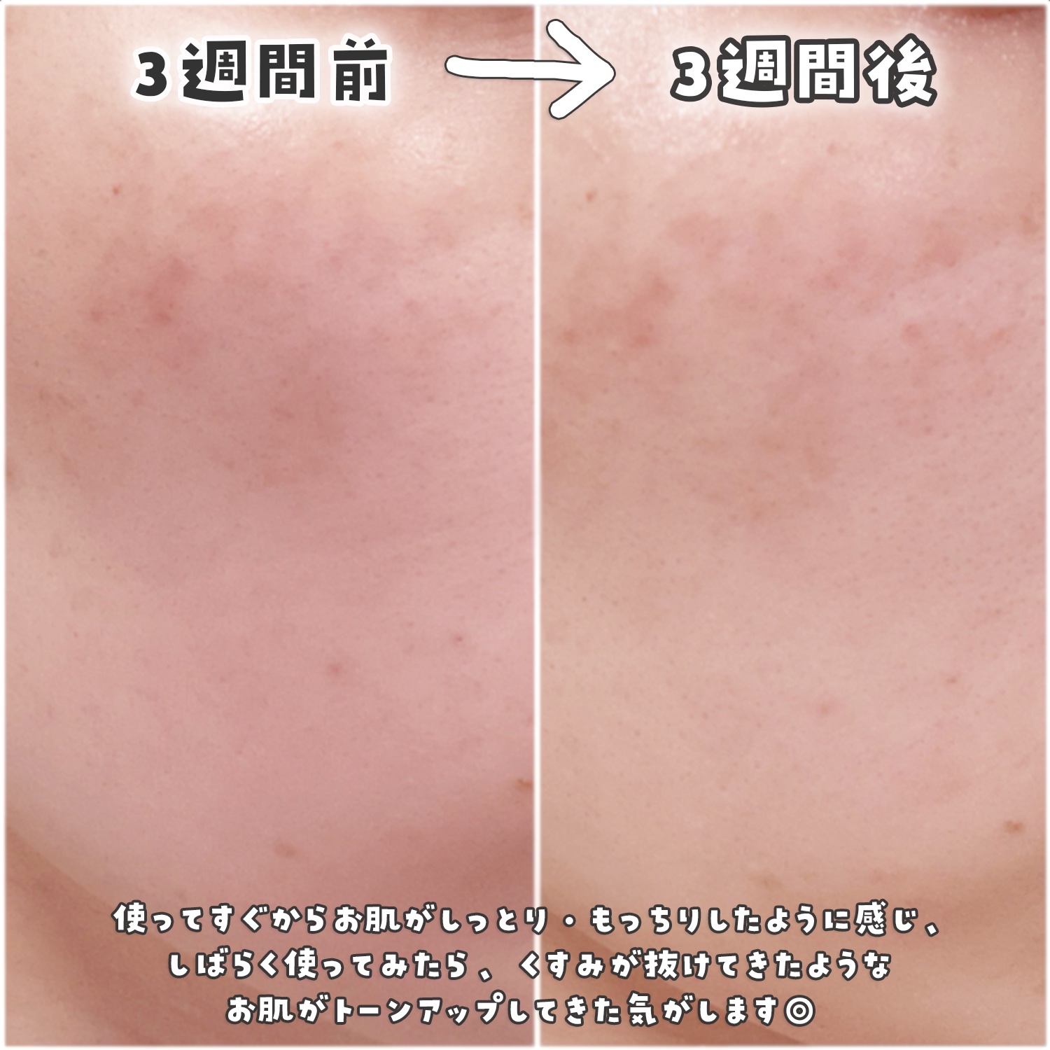 トラネキサム酸スキンブースタークリーム/MEDITHERAPY/フェイスクリームを使ったクチコミ（3枚目）