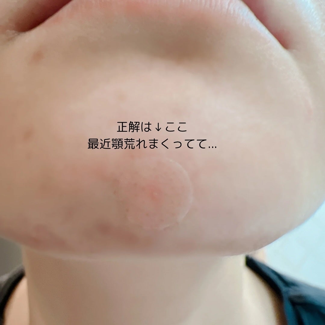 ニキパ! プレミアム 極薄透明パッチ/金冠堂/にきびパッチを使ったクチコミ(5枚目)