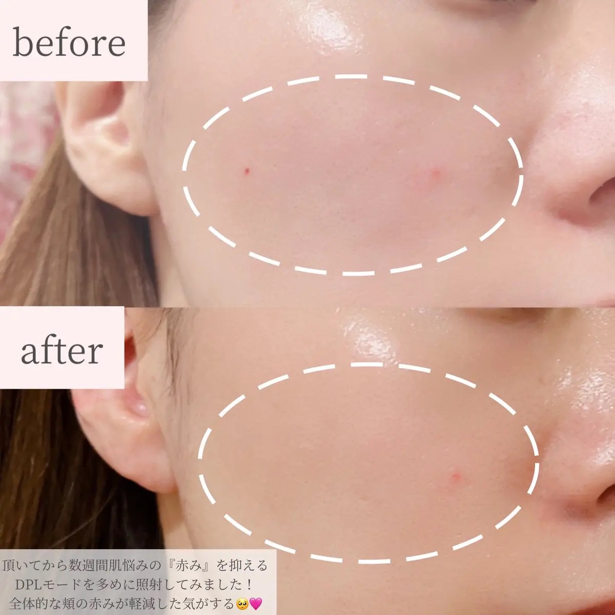 MiRAY ONE/MYTREX/美顔器・マッサージを使ったクチコミ（3枚目）